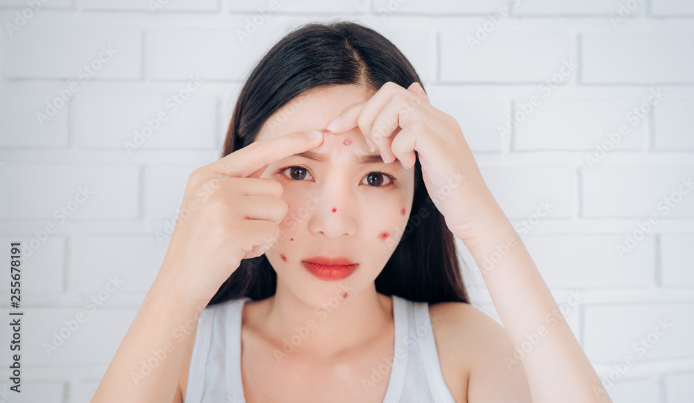 Young Asian woman squeeze acne forehead problem face looking at mirror her without Skincare.