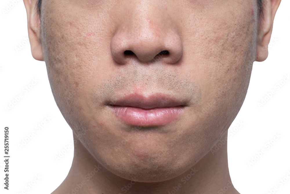 white acne scars on face