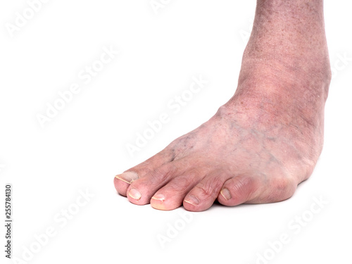 Adult male with club foot aka talipes, despite childhood intervention. Closeup, on white. © Mushy