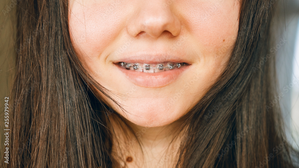 Girl with braces smiling Girl with braces smiling