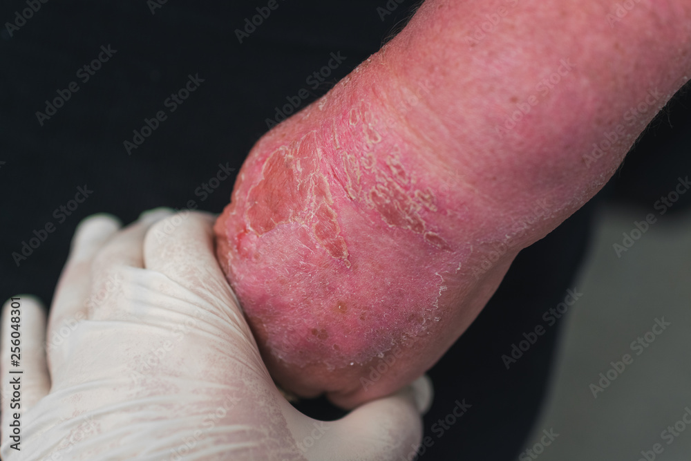 doctor examines a woman's hand burned in the sun doctor examines a woman's hand burned in the sun