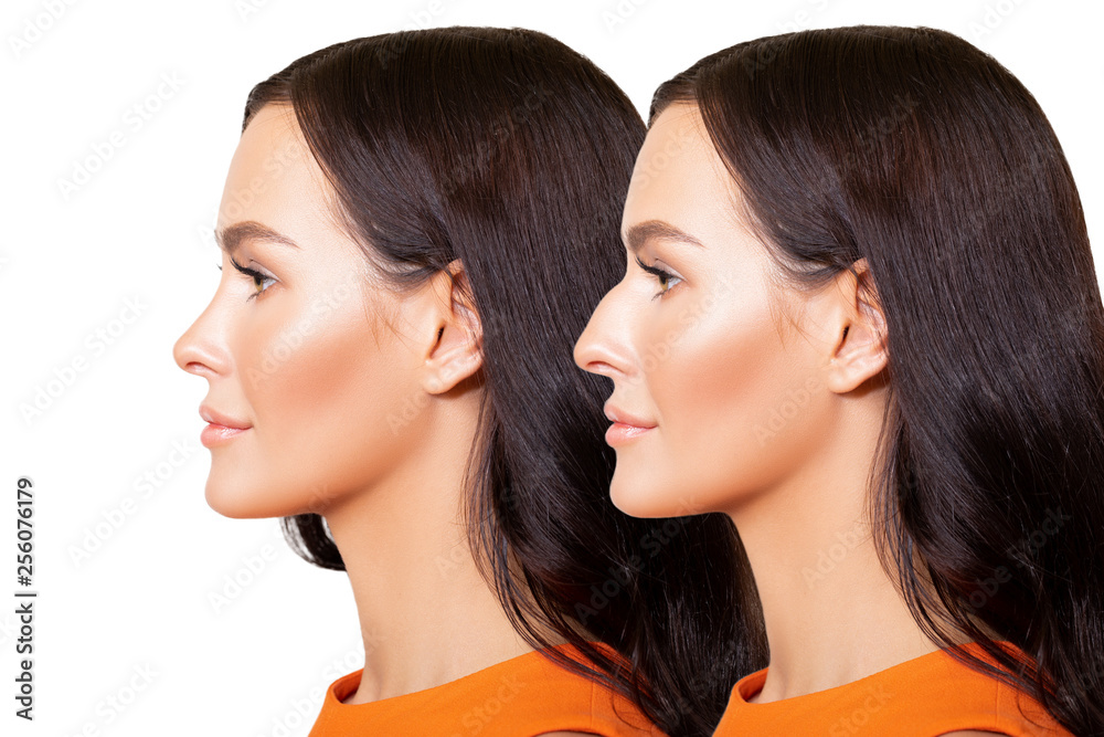 Comparison of Female nose after plastic surgery. portrait of beautiful