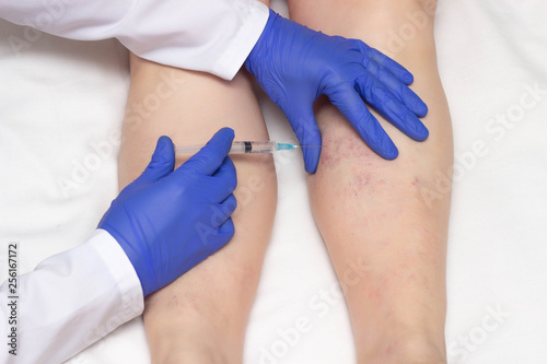 Doctor in medical gloves injects sclerotherapy procedure on the legs of a woman against varicose veins, close-up, ozone therapy, medical