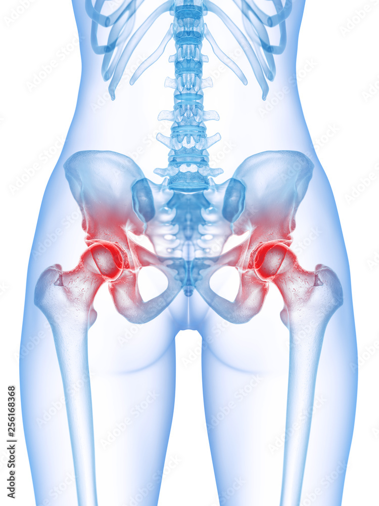 3d rendered medically accurate illustration of a painful hip joint - obrazy, fototapety, plakaty 