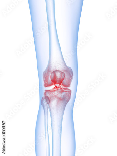 3d rendered medically accurate illustration of a painful knee
