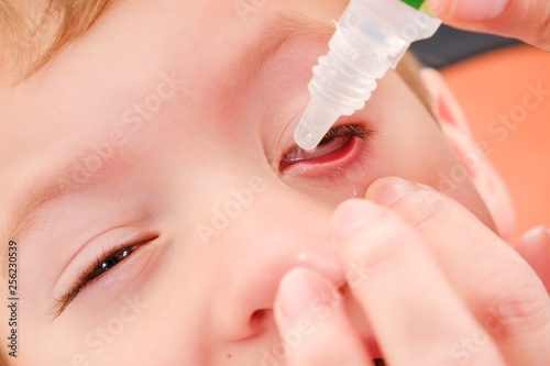 Eye child allergy and conjunctivitis red allergic, health bloodshot.