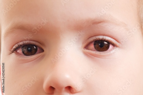 фотографія Child conjunctivitis red eye with infection,   health.