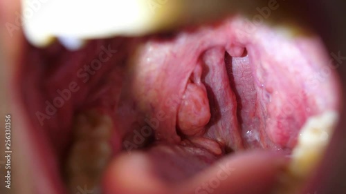 Patient With Sore Throat Examination of Strep Throat and Adenoids  photo