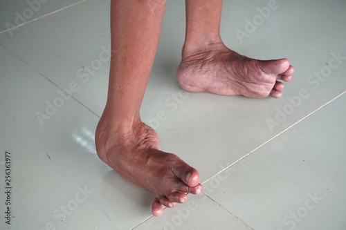 Two feet showing abnormalities Congenital called clubfoot or club foot                               photo