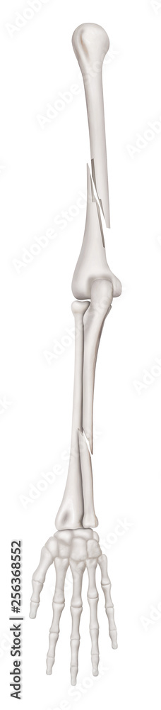 Ulna and Humerus Fractures or Broken Arms- Completed displaced fracture type-Anterior view-3D Medical-Biomedical illustration- Healthcare -Isolated on white background.