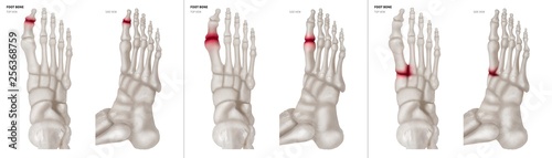 Collection Arthritis in Big toe joint foot bone red highlights on different pain area- Anterior and Lateral view- 3D medical and Biomedical illustration- Medical Concept- Isolated white background.