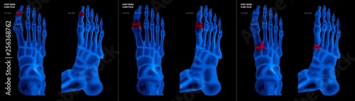 X-ray of collection arthritis big toe joint foot bone red highlights in different pain area- Anterior and Lateral view-3D medical and Biomedical illustration- Medical Concept- Blue tone color