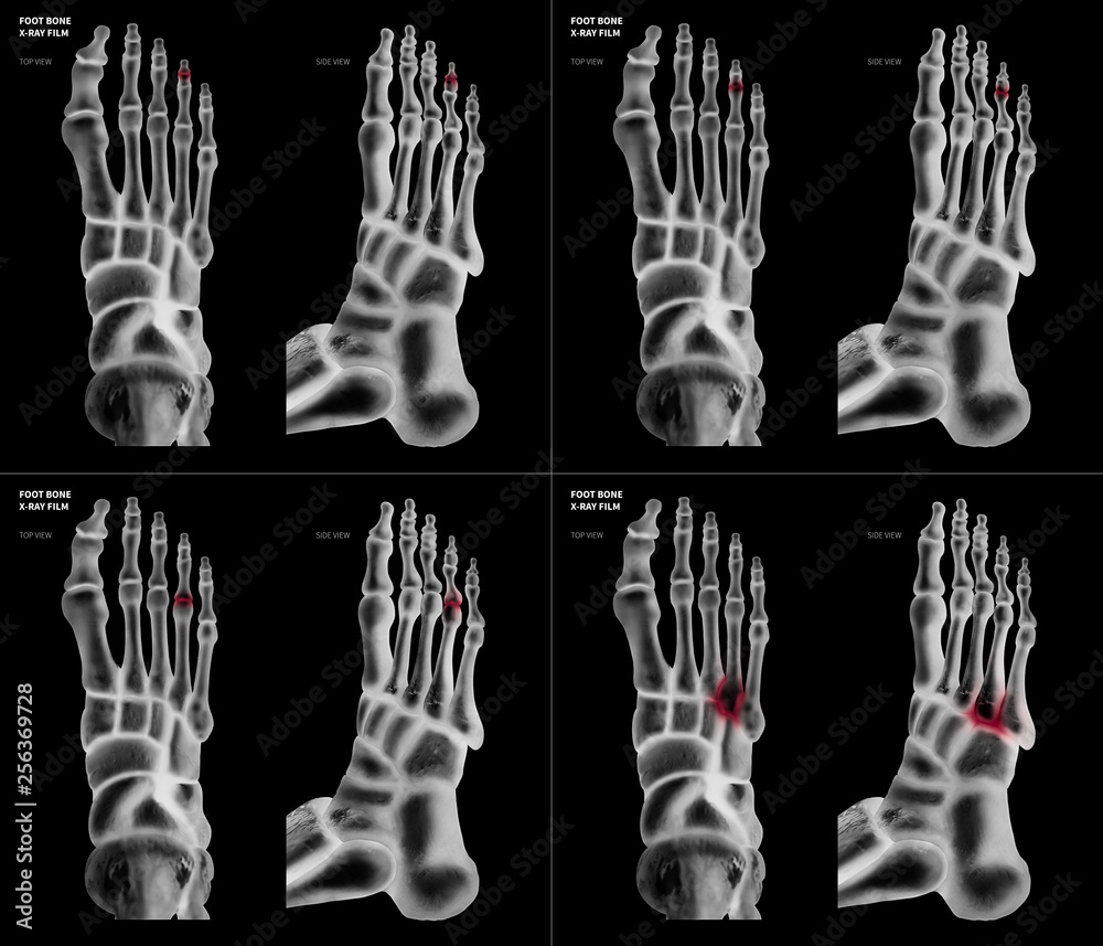 Xray of collection arthritis ring toe joint foot bone red highlights