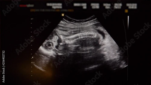 Ultrasound Of Baby In The Womb In The Second Trimester photo