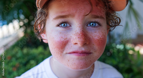 sad curly boy's face with sunburn 