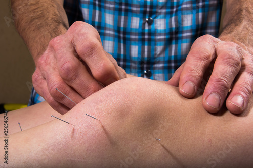 Dry Needling At The Physical Therapy Clinic - Pain Relief and Healing