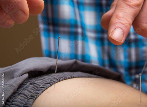 Dry Needling At The Physical Therapy Clinic - Pain Relief and Healing