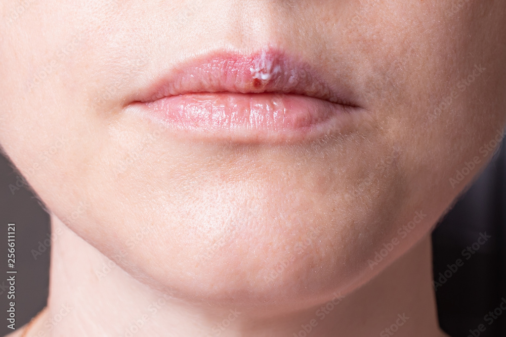 Obraz premium część kobiecej twarzy, opryszczka na ustach, koncepcja piękna