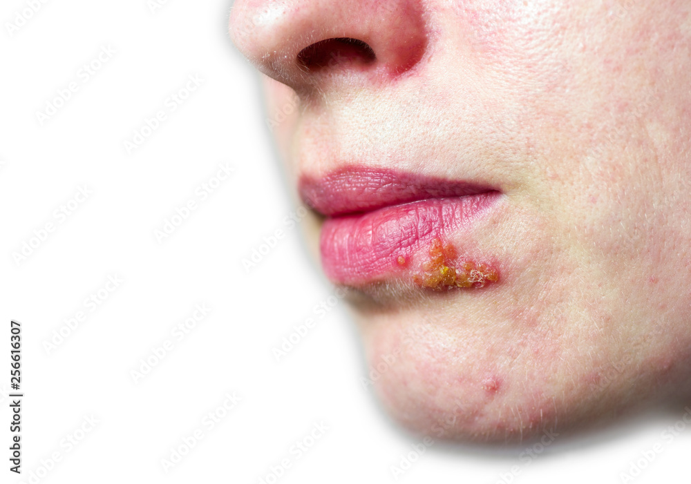 Naklejka premium Herpes on the lip