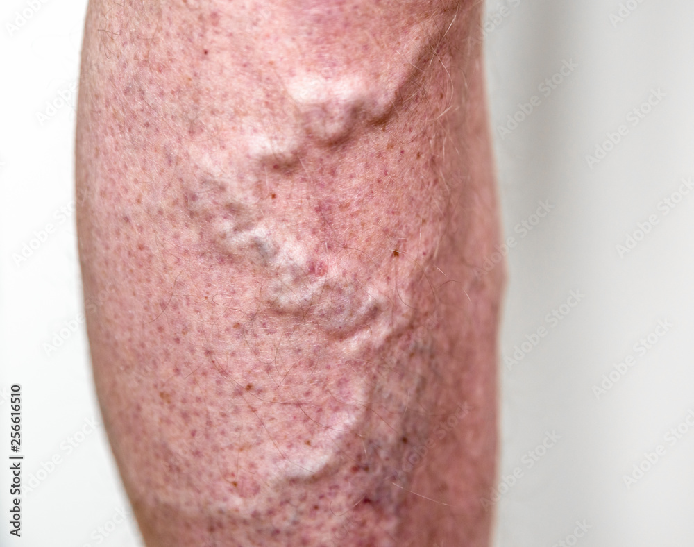 Varicose veins on leg Varicose veins on leg