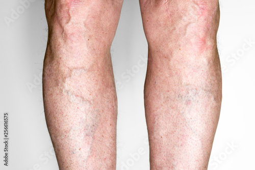 Varicose veins on legs