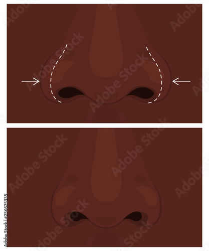 Vector illustration. Front view of a wide human nose before, after aesthetic plastic surgery - rhinoplasty (nose job). Close up view. For advertising, medical and beauty publications.