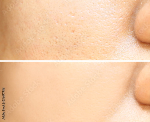 Compare before and after (retouch photo) of close up wide large pores skin on oily face have pimple of asia woman effect after use cream or treatment for facial care face skin to better photo