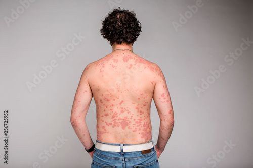 Psoriasis skin. Psoriasis is an autoimmune disease that affects the skin cause skin inflammation red and scaly photo