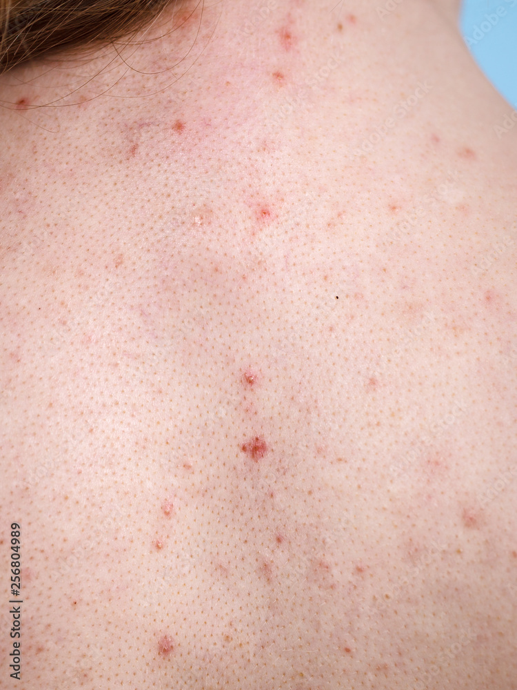 Closeup human skin with problem Closeup human skin with problem