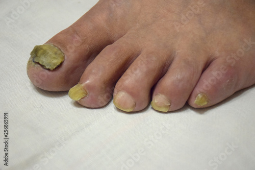 Fungal Nail Disease on the left Leg. Close up of nail fungus infection on the fingers. Fungal infection on nails leg, fingers with onychomycosis. photo