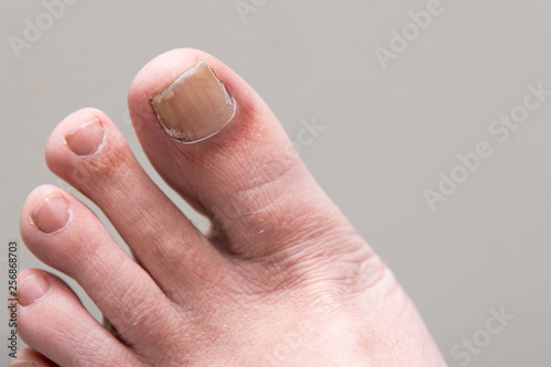 Male Foot onychomycosis with fungal nail infection photo