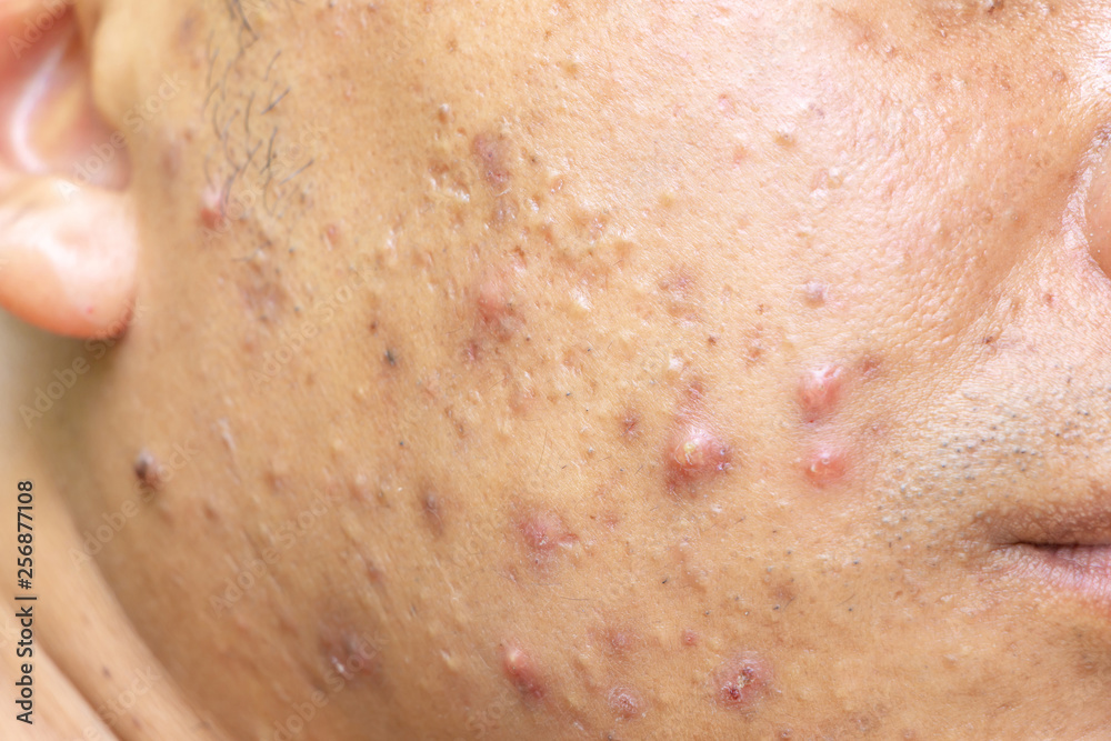 Close up photo of nodular cystic acne blemish spots skin on man face Close up photo of nodular cystic acne blemish spots skin on man face