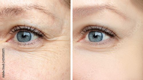 Woman face, eye wrinkles before and after treatment - the result of rejuvenating cosmetological procedures of biorevitalization, botox and pigment spots removal