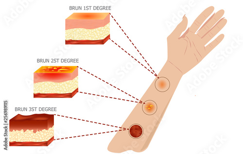 types of burns Vector illustration