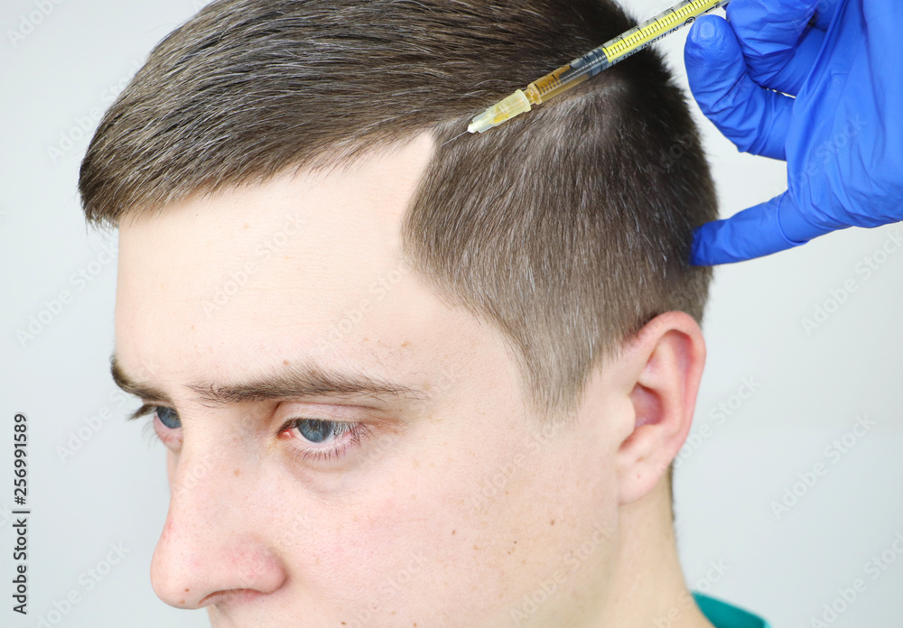 Obraz premium Hair mesotherapy or hair transplant: a beautician doctor makes injections in the man’s head for hair growth or to prevent baldness