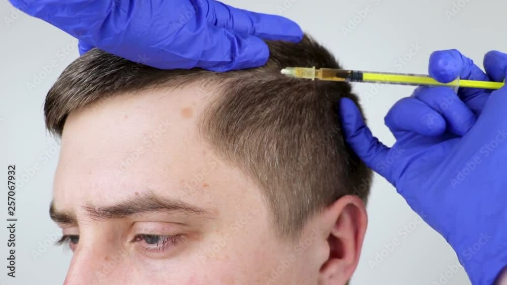 Hair mesotherapy or hair transplant: a beautician doctor makes injections in the man’s head for hair growth or to prevent baldness Hair mesotherapy or hair transplant: a beautician doctor makes injections in the man’s head for hair growth or to prevent baldness