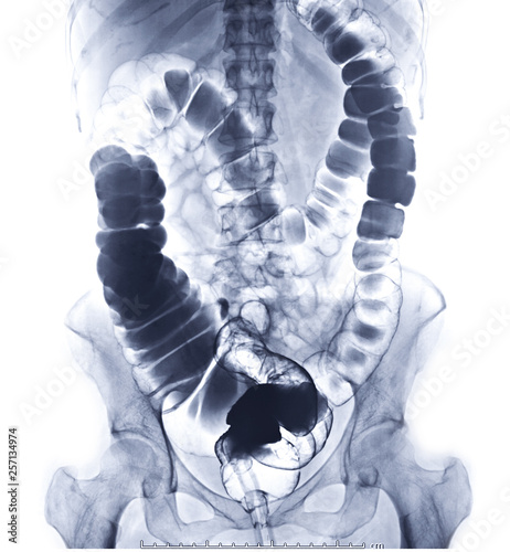 barium enema or BE is image of large bowel by injection of barium contrast into rectal  .This coats the lining of the colon and rectum and X-ray films are obtained under fluoroscopic control. photo