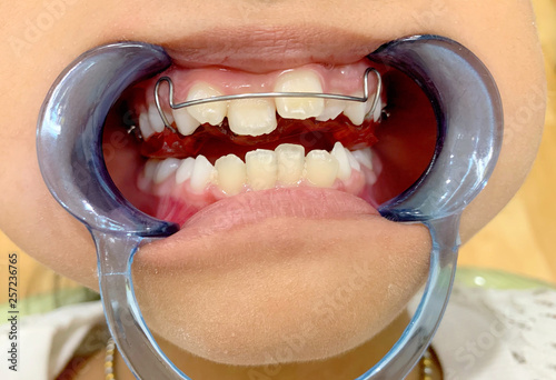 An Asian girl open her mouth with mouth gag and show removable appliance with anterior spring braces because of anterior cross bite at Pranburi hospital. Pranburi, Thailand March 1, 2019