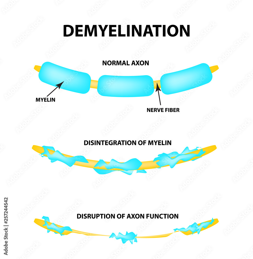 The Destruction Of The Myelin Sheath On The Axon Damaged Myelin The Destruction Of The Myelin Sheath On The Axon Damaged Myelin