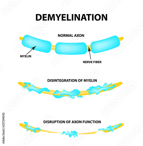 The destruction of the myelin sheath on the axon. Damaged myelin. Neuron affected by multiple sclerosis. World Multiple Sclerosis Day. Infographics. Vector illustration on isolated background. photo