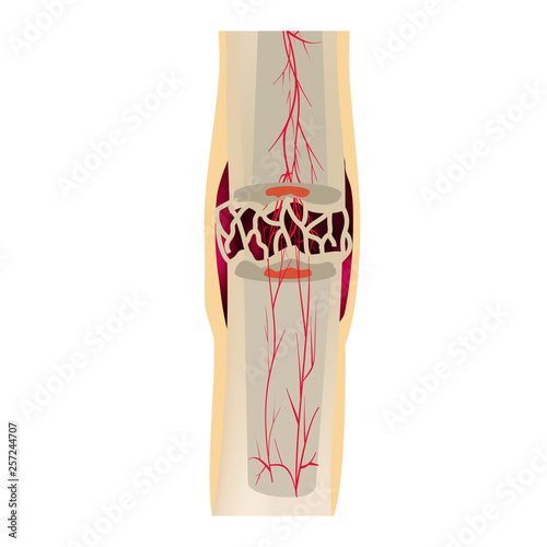 3 Stage Of Healing Bone Fracture. callus ossification. The bone fracture. Infographics. Vector illustration on isolated background.