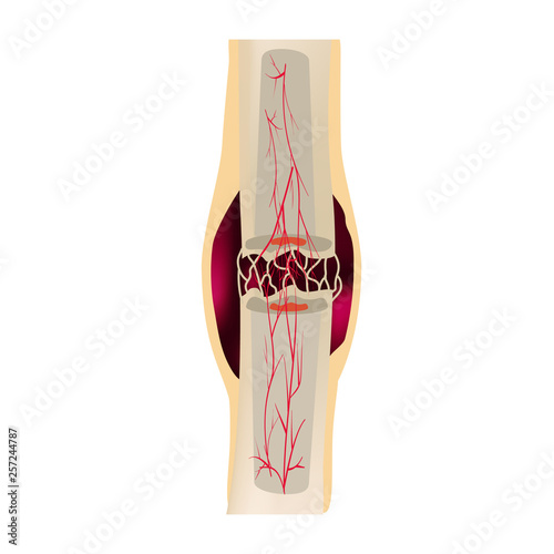 2 Stage Of Healing Bone Fracture. Formation of callus. The bone fracture. Infographics. Vector illustration on isolated background.