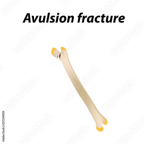 Avulsion fracture Bone. Infographics. Vector illustration on a lined background.