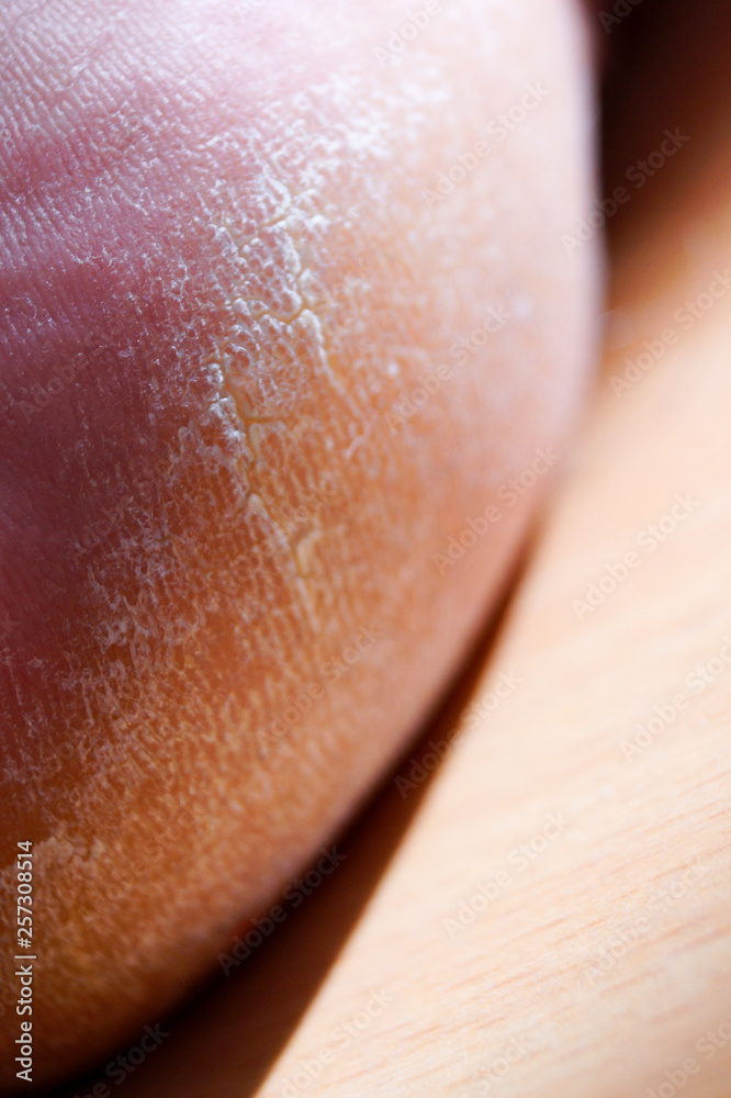 Closeup image of a heel on the foot with a white callus.