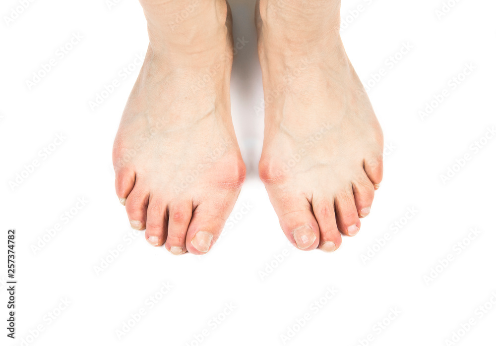 Fotografia do Stock Medical condition called bunions(Hallux abducto