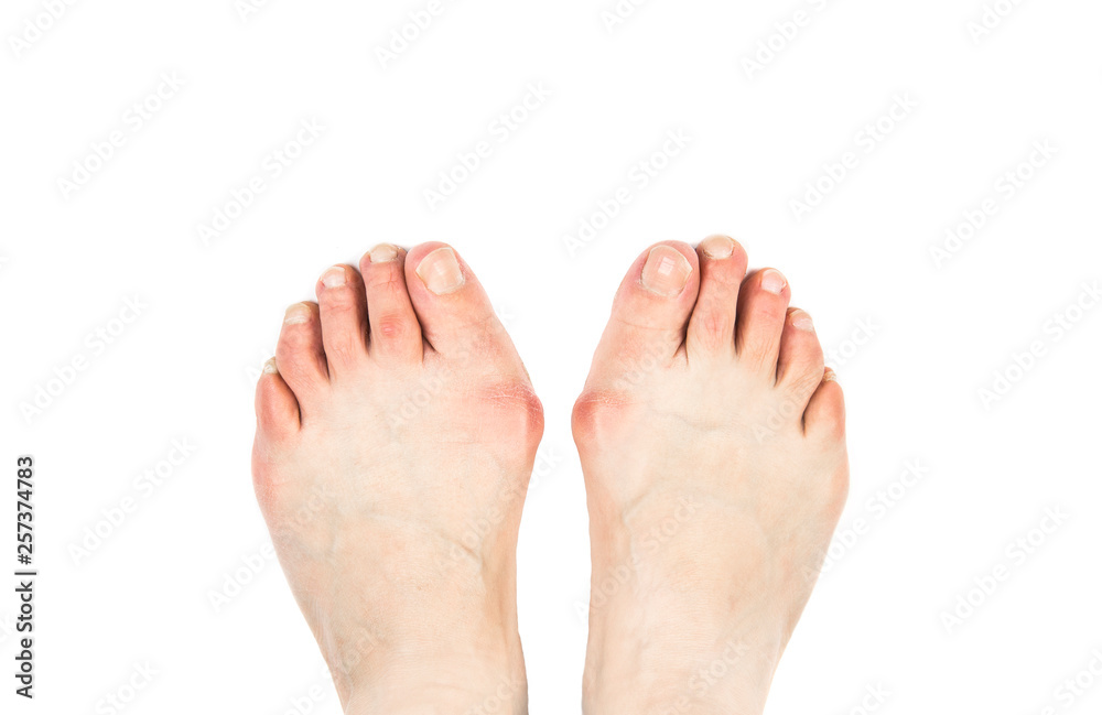 Medical condition called bunions(Hallux abducto valgus, hallux valgus, metatarsus primus varus)it is bump on the outside of the base of big toe. Close up view of 50 year old woman feet with bunions. Medical condition called bunions(Hallux abducto valgus, hallux valgus, metatarsus primus varus)it is bump on the outside of the base of big toe. Close up view of 50 year old woman feet with bunions.