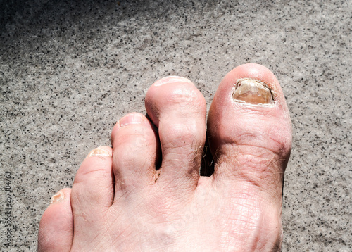 ugly male feet and toes affected by toe nail fungus and arhtritic hammertoes photo