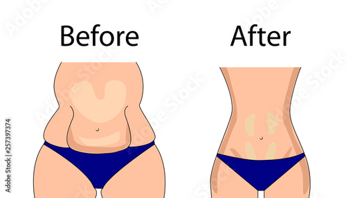 The figure is obese and normal. The problem of excess weight.