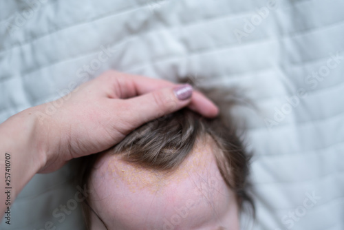 Seborrheic dermatitis on head of the baby. Newborn with seborrhea, close-up.