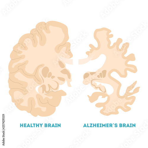 Healthy and alzheimer brain. Neurodegeneration concept illustration